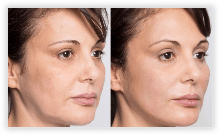 Non Surgical Facelift 1
